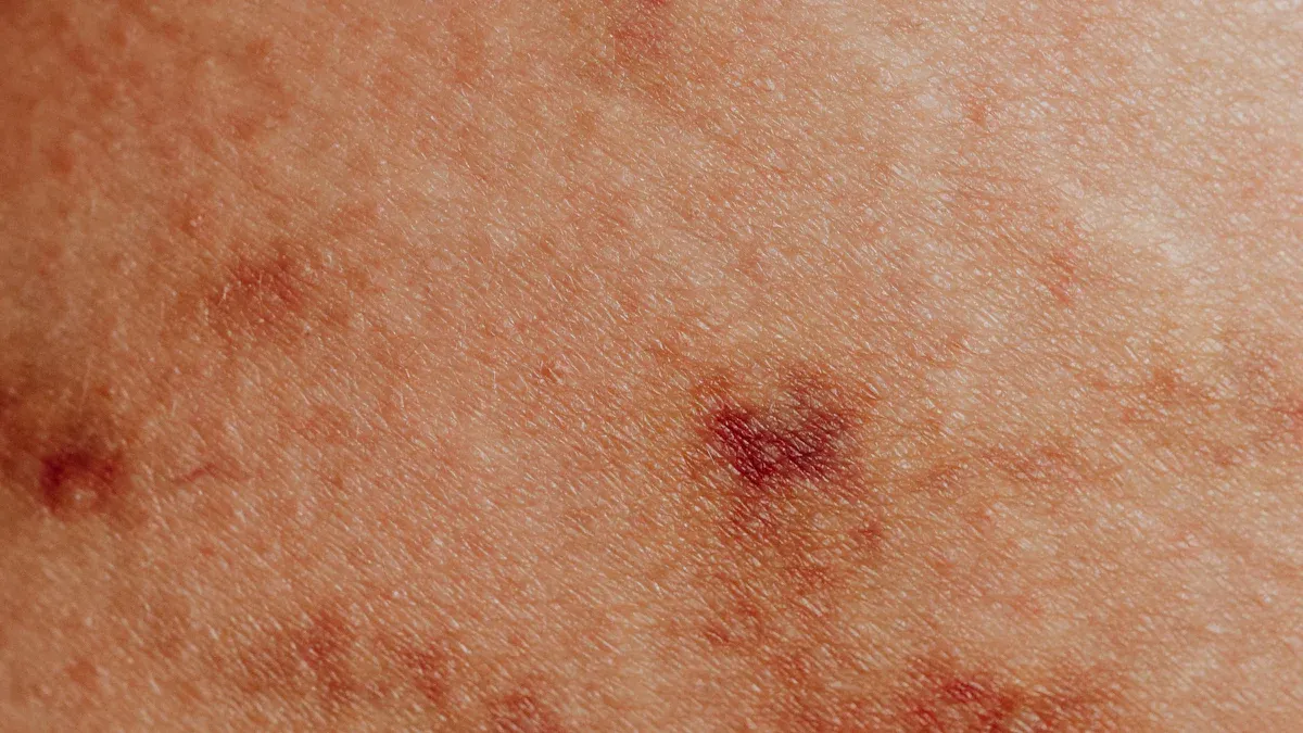 Identifying Fire Ant Stings